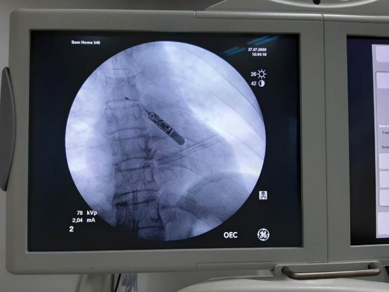 Raio-X do dispositivo implantado no paciente
