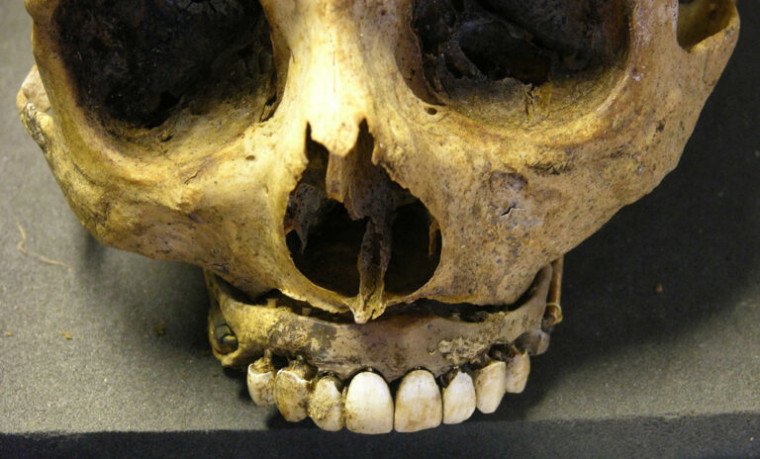 O uso macabro dos dentes de soldados mortos para produção de dentaduras no século XIX