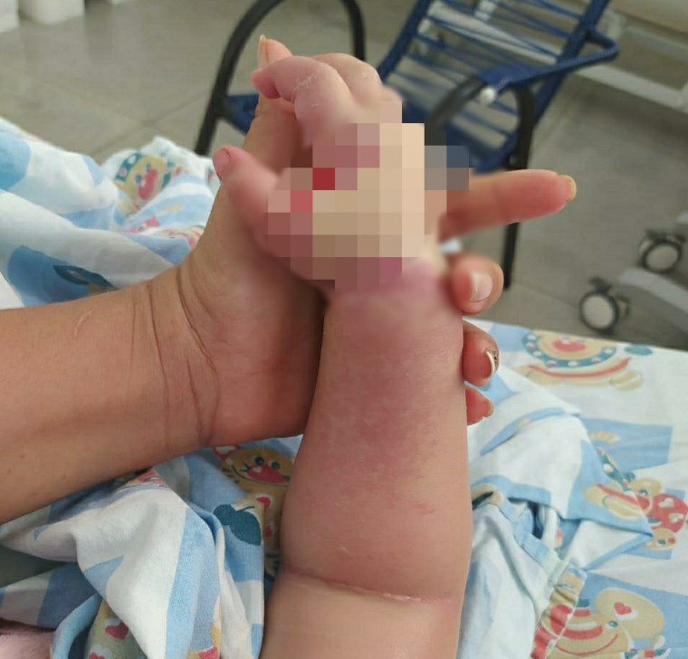 Mão da criança após receber o soro