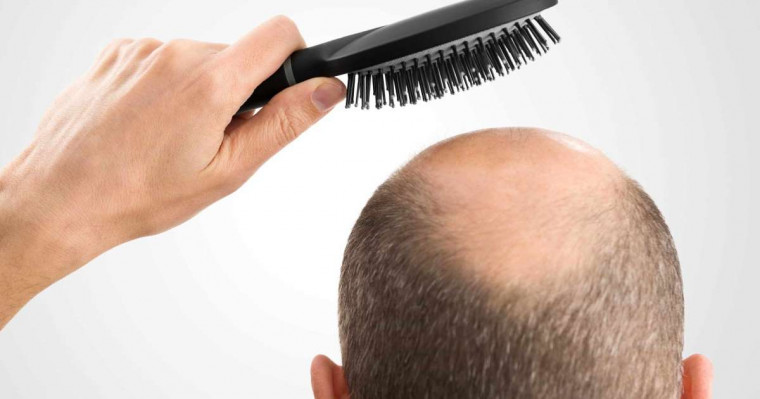 Mitos e verdades sobre a queda de cabelo