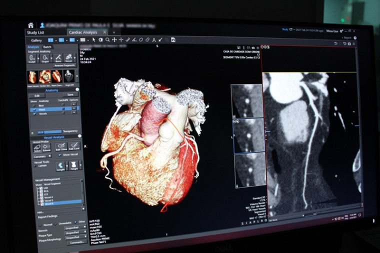Novo exame possibilita a visualização tridimensional do coração, das suas estruturas e das artérias coronarianas.