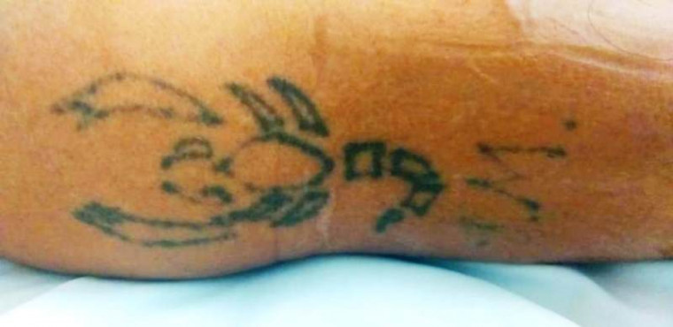 Tatuagem do paciente