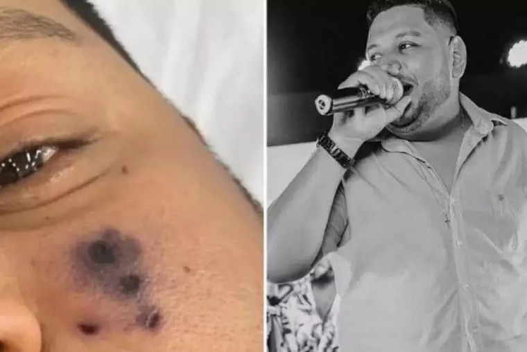 Rosto do cantor Darlyn Morais começou a ficar escuro no local da picada