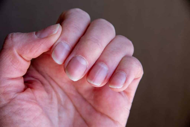 O que suas unhas revelam sobre sua saúde: descubra os sinais de alerta!